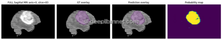 3D Medical Image Segmentation