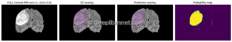 3D Medical Image Segmentation