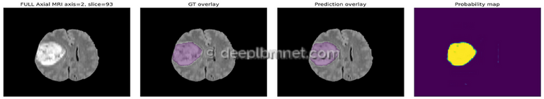 3D Medical Image Segmentation