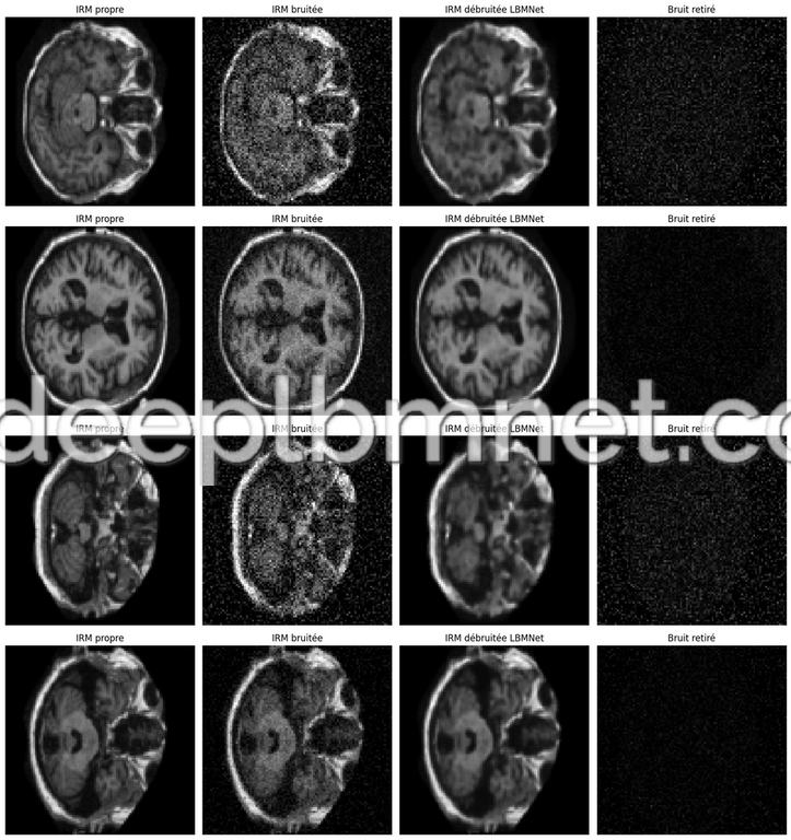 LBMNet is a new architecure for Medical MRI Image Denoising based in the lattice Boltzmann Method