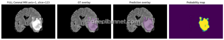 3D Medical Image Segmentation