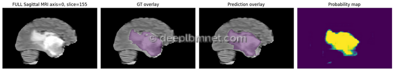 3D Medical Image Segmentation